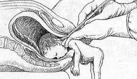 partial-birth-abortion